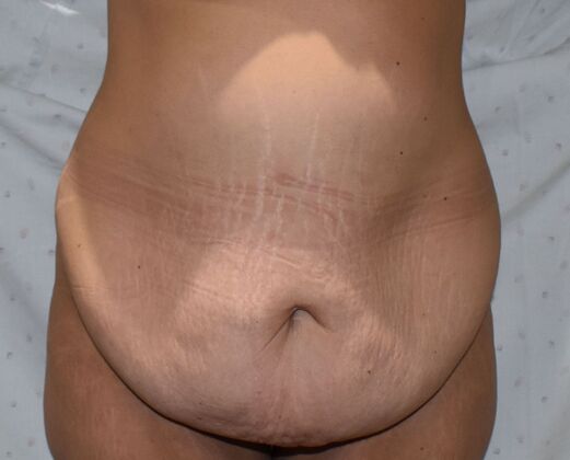 Tummy Tuck (Abdominoplasty): Case 426 - Before