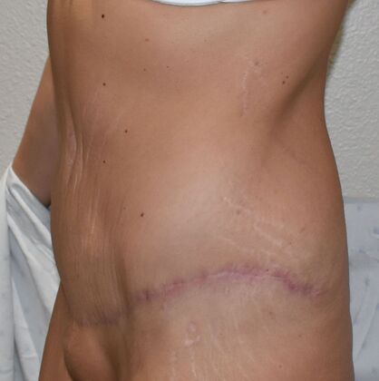 Massive Weight Loss : Case 132 - After