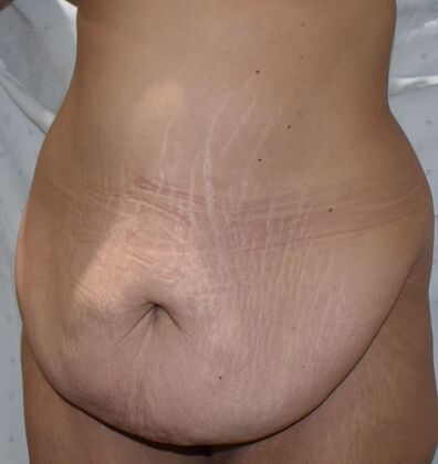 Massive Weight Loss : Case 132 - Before