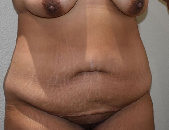 Tummy Tuck (Abdominoplasty): Case 427 - Before