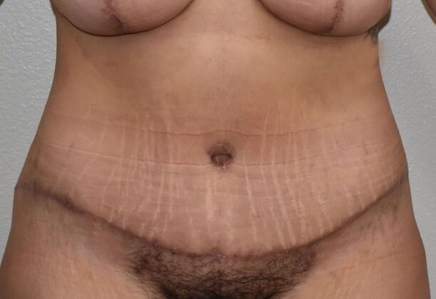 Tummy Tuck (Abdominoplasty): Case 427 - After