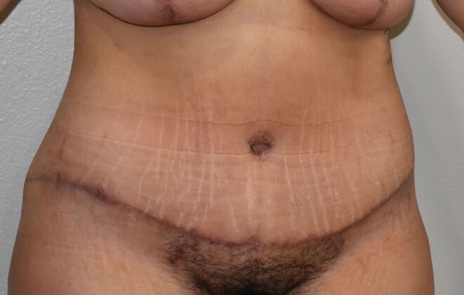 Tummy Tuck (Abdominoplasty): Case 427 - After
