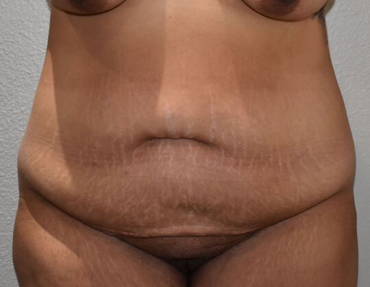 Massive Weight Loss : Case 133 - Before