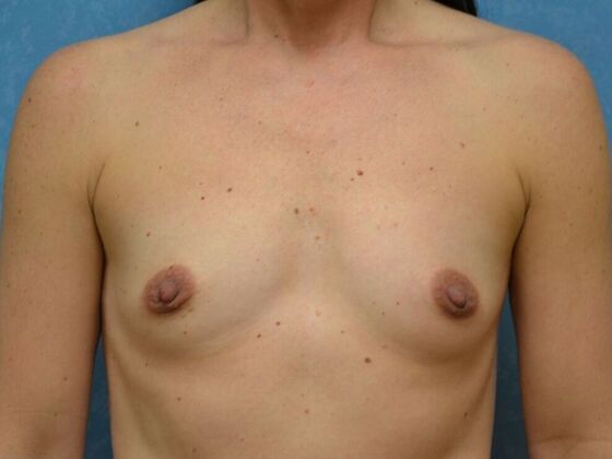 Breast Augmentation Case 1771- Maumee, OH - Before