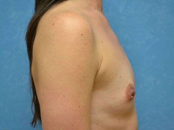 Breast Augmentation: Case 1771- Maumee, OH - Before