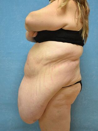 Bodylift: Case 1615- Pioneer, OH - Before