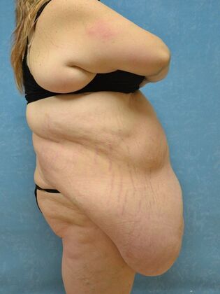 Bodylift: Case 1615- Pioneer, OH - Before