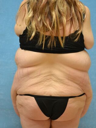 Bodylift: Case 1615- Pioneer, OH - Before