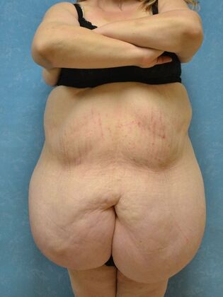 Bodylift: Case 1615- Pioneer, OH - After