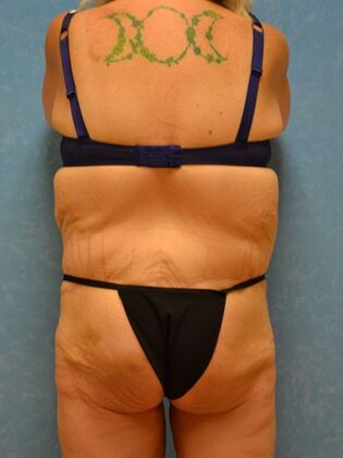 Bodylift: Case 1615- Pioneer, OH - After