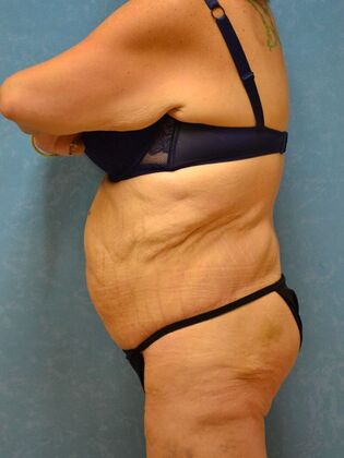 Bodylift: Case 1615- Pioneer, OH - After