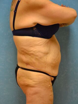 Bodylift: Case 1615- Pioneer, OH - After