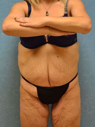 Bodylift: Case 1615- Pioneer, OH - Before