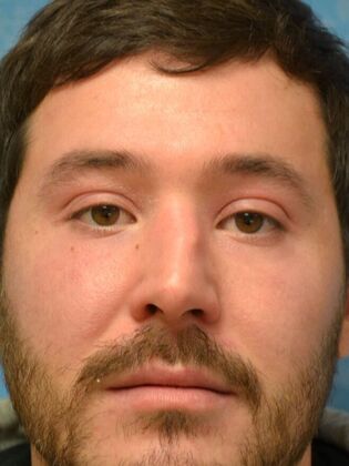 Rhinoplasty: Case 1734- Swanton, OH - Before