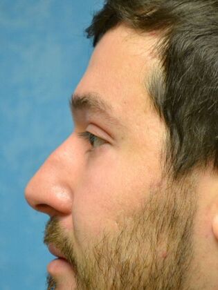 Rhinoplasty: Case 1734- Swanton, OH - Before