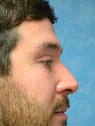 Rhinoplasty: Case 1734- Swanton, OH - Before