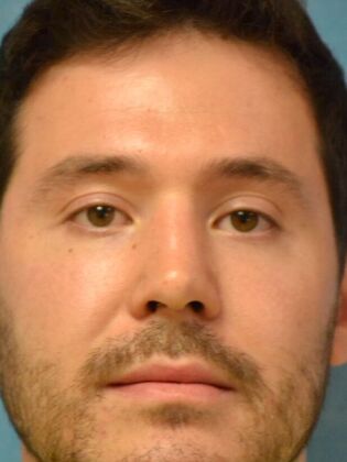 Rhinoplasty: Case 1734- Swanton, OH - After