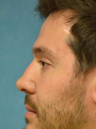 Rhinoplasty: Case 1734- Swanton, OH - After