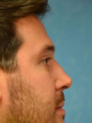 Rhinoplasty: Case 1734- Swanton, OH - After