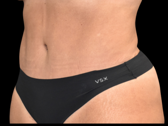 Abdominoplasty: Case 2 - After