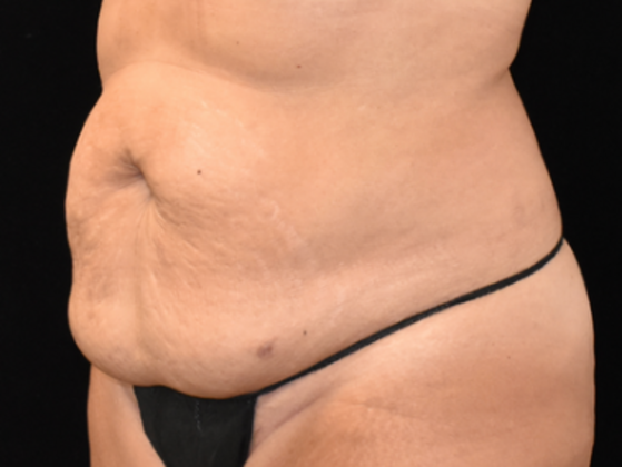 Abdominoplasty: Case 2 - Before