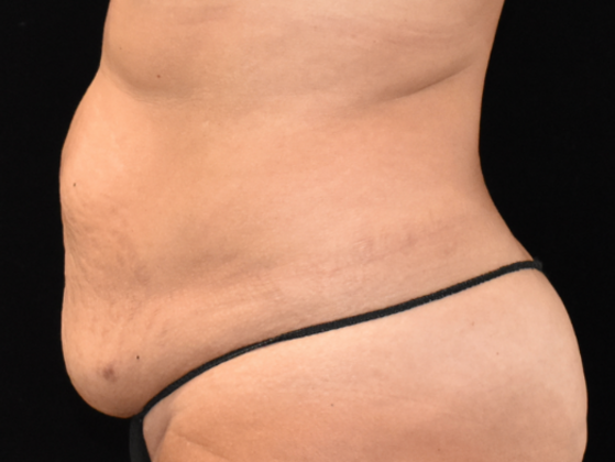 Abdominoplasty: Case 2 - Before