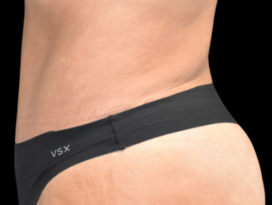 Abdominoplasty: Case 2 - After