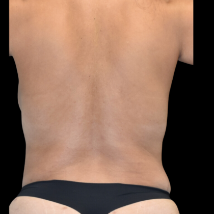 Abdominoplasty: Case 2 - After