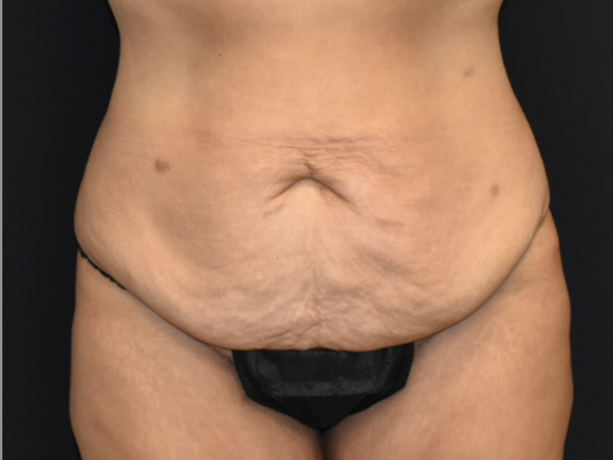 Abdominoplasty Case 3 - Before
