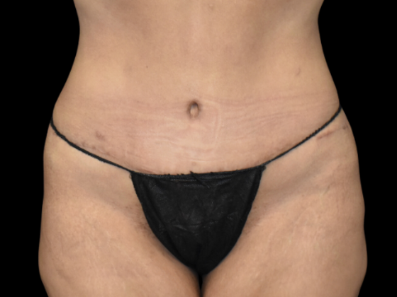 Abdominoplasty Case 3 - After