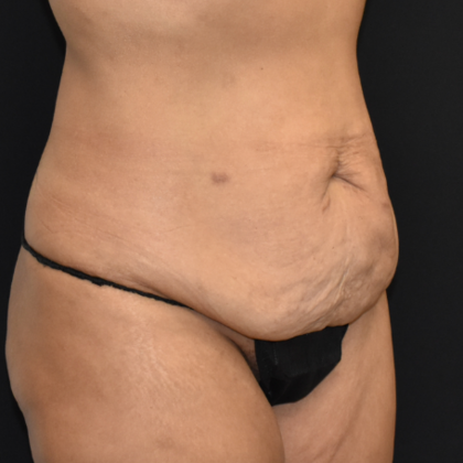 Abdominoplasty: Case 3 - Before