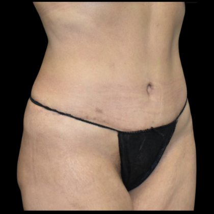 Abdominoplasty: Case 3 - After
