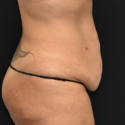 Abdominoplasty: Case 3 - Before
