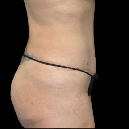 Abdominoplasty: Case 3 - After