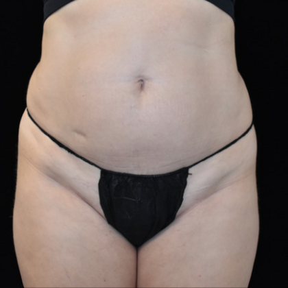 Abdominoplasty Case 4 - Before