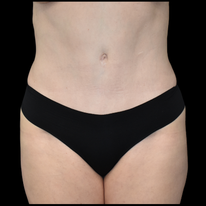 Abdominoplasty Case 4 - After