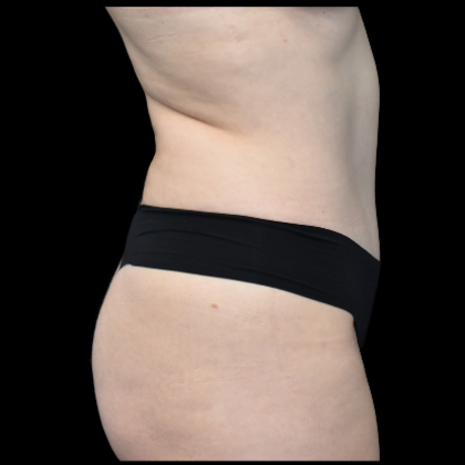Abdominoplasty: Case 4 - After