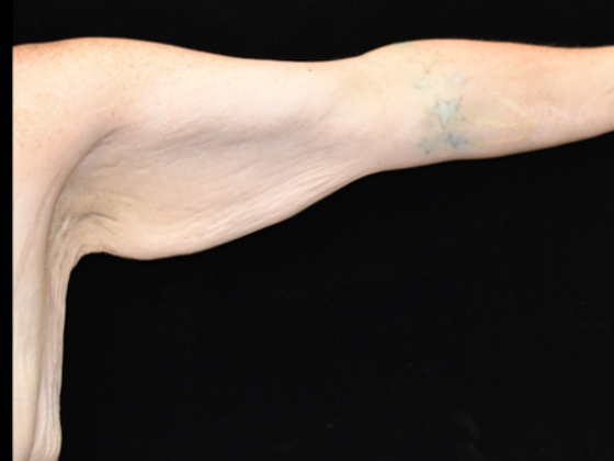 Brachioplasty: Case 1 - Before