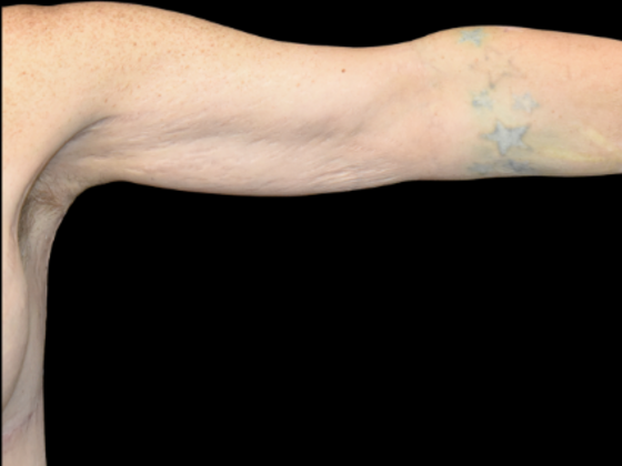 Brachioplasty: Case 1 - After