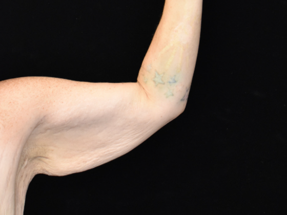 Brachioplasty Case 1 - Before