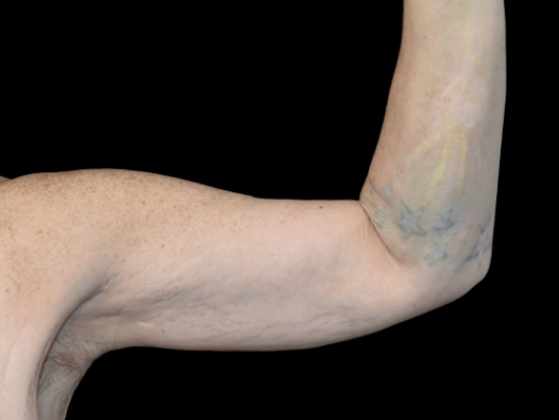 Brachioplasty Case 1 - After