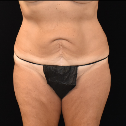 Abdominoplasty Case 5 - Before