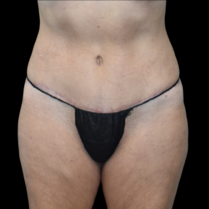 Abdominoplasty Case 5 - After