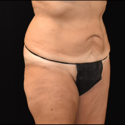 Abdominoplasty: Case 5 - Before