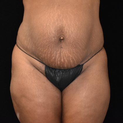 Abdominoplasty Case 6 - Before