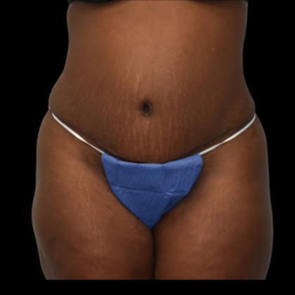 Abdominoplasty Case 6 - After