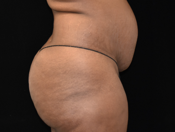 Abdominoplasty: Case 6 - Before