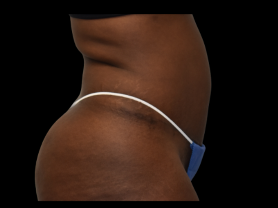 Abdominoplasty: Case 6 - After