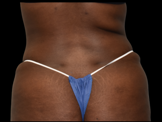 Abdominoplasty: Case 6 - After