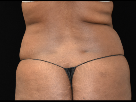 Abdominoplasty: Case 6 - Before